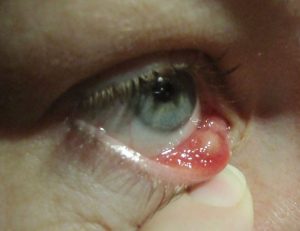 chalazion