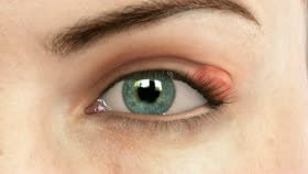 Chalazion Bump On Eyelid