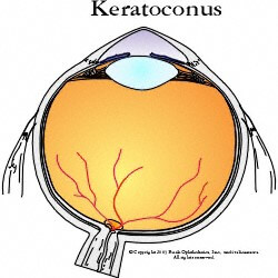 keratoconus