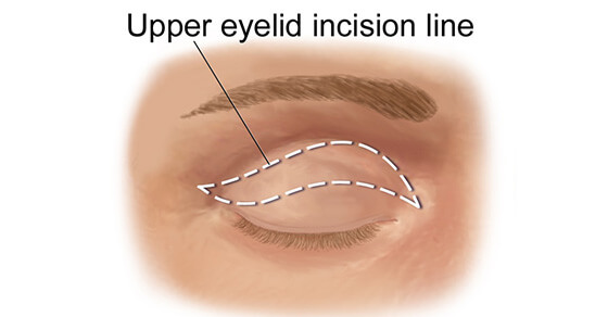 Upper Eyelid Incision Line