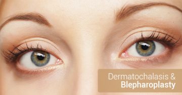 Dermatochalasis & Blepharoplasty