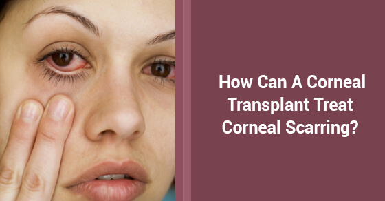 How Can A Corneal Transplant Treat Corneal Scarring?