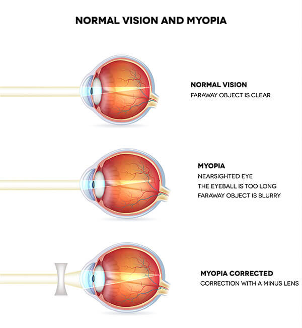 Chart Illustrating How Myopia Affects an Eye