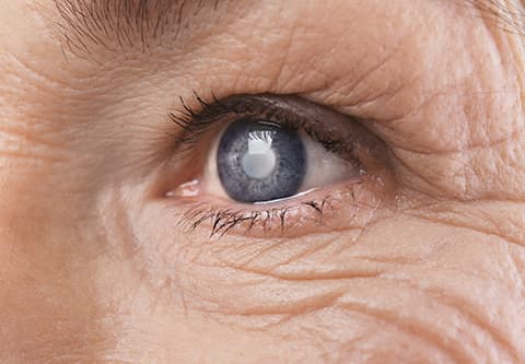 Closeup of a Cataract in a Woman's Eye