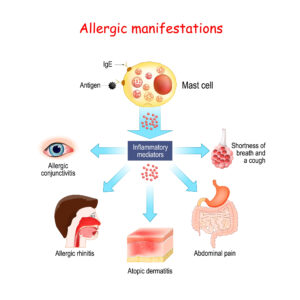 anatomy of allergic manifestation