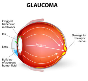 diagram of glaucoma